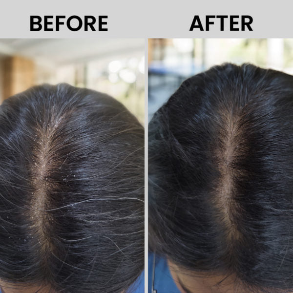 Tru Hair & Skin Onion Hair Oil for Stronger, Healthier Hair - 100ml | CRED