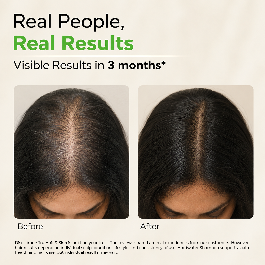 Hard Water Shampoo | For Ultra Soft , Shiny and Dandruff Free Hair