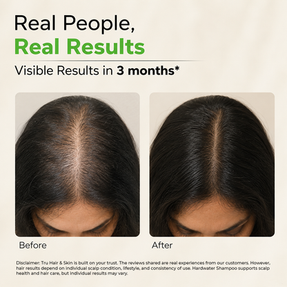 Hard Water Shampoo | For Ultra Soft , Shiny and Dandruff Free Hair