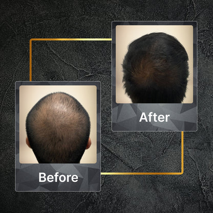 Ayurvedic Hair Oil with Free Heater |  Fights Dandruff, Hair Fall Control, Hair Growth & Shiny Hair | 50ml